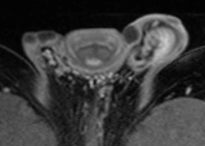 Figure 4 MRI in transaxial position with enhancement, the nodules show peripheral fine line enhancement.