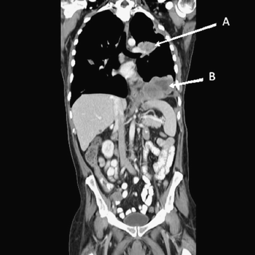 Figure 3. CT scan performed on 6/20/2008 after 4 months of sunitinib therapy. The pleural (A) and diaphragmatic (B) tumors measured 31.1mm and 57.1mm, respectively, in the vertical dimension.