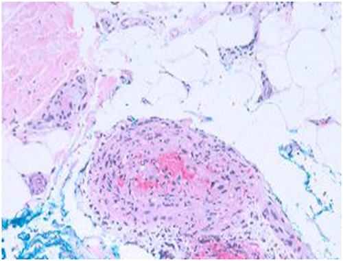 Figure 2 Hematoxylin-eosin (original magnification ×40). Histologic examination of an excisional biopsy revealed medium-sized vessel arteritis in the upper subcutis showing lymphocytes and few neutrophils within the vessel wall with incipient necrotizing features and plumped endothelium.