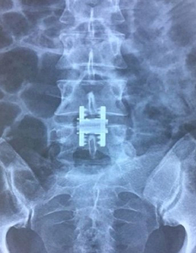 Figure 1 Image of the Device and its Placement in the Spine. AP Radiograph of the Deployment of the Device.