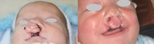 Figure 5. Patient with bilateral cleft lip and palate before (left) and after (right) nasoalveolar moulding.