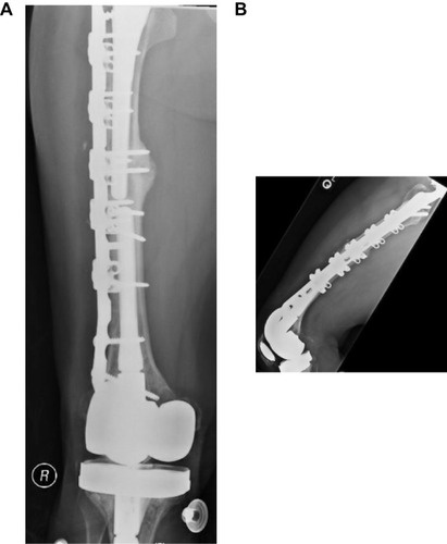 Figure 6 Anteroposterior (A) and lateral (B) radiographs of a stemmed revision total knee arthroplasty following periprosthetic fracture around a loose total knee prosthesis. Fixation is supplemented with a long lateral locking plate and several adaption plates to maximize screw purchase around the stems. Abundant callus is noted around the stem junction indicating a robust healing response.