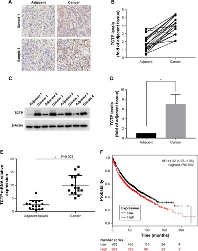 Figure 1 TCTP is overexpressed in lung carcinoma.Notes: (A) Representative immunohistochemistry results of two lung adenocarcinoma tissues and paired adjacent tissues. (B) TCTP level in 24 paired lung adenocarcinoma and adjacent tissues evaluated by immunohistochemistry. (C) Representative Western blot showing TCTP protein levels in four paired lung adenocarcinoma and adjacent tissues, with β-actin protein level as internal control. (D) Normalized expression of TCTP proteins in all 24 paired lung cancer and adjacent tissues; the values are presented in the grayscale of the Western blot stripe as mean ± SD. (E) TCTP transcriptional level in 24 paired lung cancer and adjacent tissues evaluated by real-time PCR (*P<0.01). (F) Kaplan–Meier survival curves showing high or low TCTP expression levels in lung cancer patients.