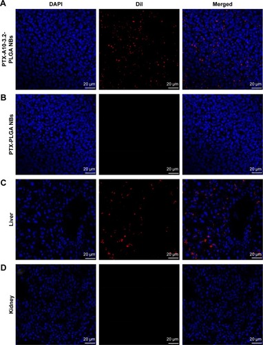 Figure 10 Distribution of different formulations of DiI-labeled NBs in the cryosections of different organ tissues by LCSM and IOD in the different organ tissues.Notes: (A–E) Distribution of different formulations of DiI-labeled NBs in the tumor, liver, spleen, and kidney. (F) IOD in the tumor, liver, spleen, and kidney. PTX-PLGA NBs compared with PTX-A10-3.2-PLGA NBs, ***P<0.001. Blue indicates cell nuclei; red dots indicate DiI-labeled NBs.Abbreviations: DAPI, 4′,6-diamidino-2-phenylindole; DiI, 1,1′-dioctadecyl-3,3,3′,3′-tetramethylindocarbocyanine perchlorate; IOD, integrated optical density; LCSM, laser confocal scanning microscopy; NBs, nanobubbles; PLGA, poly(lactide-co-glycolic acid); PTX, paclitaxel.