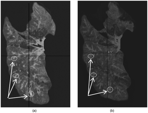 Figure 2. Result of the CT image construction. (a) Acquired CT image of the totally deflated lung for the purpose of validation. (b) Constructed CT image of the totally deflated lung. Quantitative evaluations performed on the tumor center and its boundaries, as well as on a number of anatomical features (a few of which are indicated by arrows), confirmed a sub-millimetric accuracy for the constructed CT image.