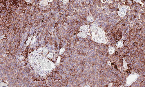 Figure 1. Urothelial carcinoma showing strong and diffuse expression for PD-L1 on tumor cells assessed by immunohistochemistry with the antibody 22C3 Dako (20x)