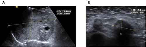 Figure 2 The outcome of breast and axillary B ultrasonography. (A) B ultrasonography showed a 12.5-cm diameter mass in the lateral quadrant of the right breast. (B) B ultrasonography showed enlarged axillary lymph nodes. The larger node had a diameter of 1.2 cm.