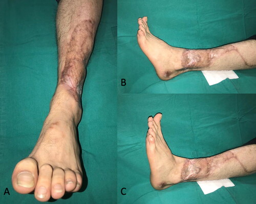 Figure 10. Post-operative first-year image of the patient demonstrates no existing functional deficit in foot dorsiflexion (C) and plantar flexion (B) movements.