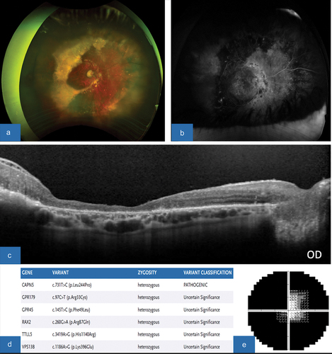 Figure 4. (A) color fundus photograph, OD, showing the presence of a thin posterior retina, mid-peripheral subretinal exudates, and attenuation of the vessels. The superior retina has evidence of crystalline deposits and exudates at the site of previous tractional retinal detachment after undergoing repair with pars plana vitrectomy. (B) FA, OD, revealing vast areas of non-perfusion along the periphery of the retina with leakage and late staining of the optic disc. (C) OCT macula, OD, demonstrating severely diminutive and thin retina, with diffuse thinning of choriocapillaris and a disorganized outer retinal layer with poor foveal contour. (D) SPARK genetic testing showing gene mutations and variants, consistent with pathogenic CAPN5 mutation. (E) HVF 30–2, OD, demonstrating severe depression of all points with some central sparing.