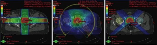 Figure 2 Comparison of treatment plans in a patient with prostate cancer. Shown is a typical slice of the planning CT in the pelvis with different radiation plans calculated: left image: Conventional 4-field 3D-conformal plan; middle image: intensity-modulated volumetric arc plan, right image: 4-field proton plan. The arrows show the target contour (prostate, red), the rectum (black with inflated rectum balloon), and the hips. Red signifies high dose volume, green intermediate dose volume, and blue low dose volume. The rectum is the major organ that has to be spared from radiation in the case of prostate cancer. To protect the rectum, an endorectal balloon is inserted before every radiation fraction and inflated with air. The rectum balloon serves to move major parts of the rectal wall away from the prostate and the high dose volume. The volumetric arc plan spares the rectum much better and conforms the dose better to the prostate than the 3D plan. In comparison, the proton plan shows equal target coverage as the VMAT plan, but much less dose delivery to the surrounding tissue, especially the rectum and both hip bones. Copyright ©2013. Swiss Physical Society. Image and figure caption reproduced from Lang S and Riesterer O. Progress in Physics: Modern Techniques in Radiation Oncology. SPG Mitteilungen. 2013;41(36): 19–22.Citation109