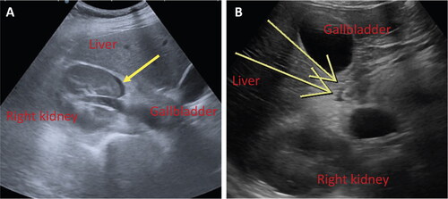 Figure 1. (A, B). Abdominal ultrasound scans. Minimal perirenal (1A) and periduodenal (1B) fluid (yellow arrows).