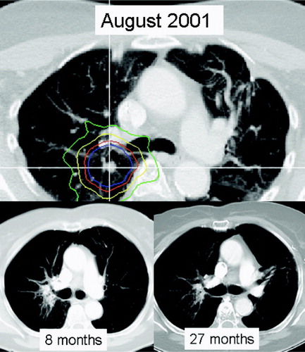 Figure 1.  Central colorectal cancer metastasis; solitary remaining manifestation following resection of left sided colorectal cancer metastasis. Prescribed dose was 36 Gy (displayed is the 100% isodose in blue, 90% in red, 70% in yellow, and 50% in green). Two follow-up CTs at 8 and 27 months document complete tumor response and focal fibrosis. The patient expired at 41 months without evidence of clinically relevant lung toxicity of systemic progressive disease. This patient underwent two additional SBRT courses for new lung metastases.