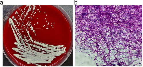Figure 2 Microbiology detection of N. gipuzkoensis. (a) The traditional culture of cerebral abscess with the pale yellow, rough, and dry colonies on Columbia Blood Agar medium. (b) The characteristic of weakly acid-fast was identified by acid-fast staining.