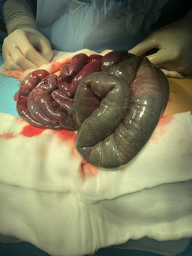 Figure 3 An intraoperative aspect of mesenteric ischemia with extensive necrosis of almost all of the small bowel.