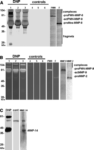 Figure 3.  Western blotting of collagenase-2 (MMP-8) (panel A), zymography and Western blot of gelatinase (MMP- 2 and -9) (panel B) and membrane-type I matrix metalloproteinase (MMP-14, panel C) in urine from DNP patients (lanes 1–3, DNP) and healthy controls (lanes 4–6, cont). Also in DNP, but not in urine of healthy control, high molecular weight (>80 kDa) MMP-8 and (>92 kDa) MMP-9 complexes could be detected. Human PMN- and rheumatoid synovial fibroblast-culture media were used as positive control for PMN- and mesenchymal (Mes)-type MMP-8 isoforms and for MMP-9 and -2. Also pure human MMP-2, -9, and -14 were used as positive controls. Mobilities of the molecular weight markers are indicated on the left.