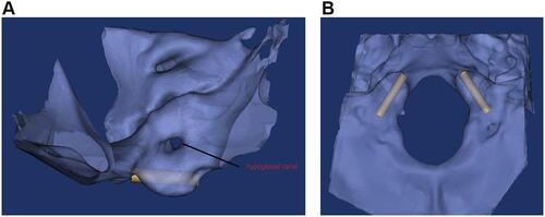 Figure 3 The sagittal (A) and axial (B) views of anterior occipital condyle screw fixation, and hypoglossal canal which was not injured by screw.