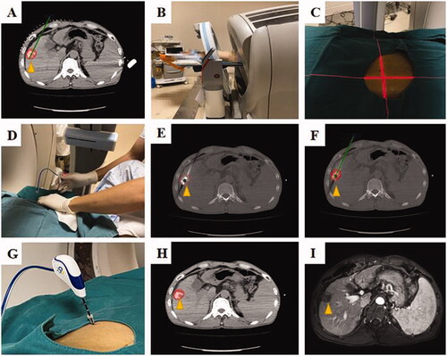 Figure 4. A 56 years, male patients with HCC (the lesion located on the liver segment V, and the maximum tumor diameter is 2.4 cm) who underwent robotic position for antenna in CT-guided microwave ablation was shown. In order to show the target more clearly on the CT image, this patient received hepatic artery embolization before ablation, and the location of the tumor in the target area was determined by lipiodol deposition. (A) Pre-ablation planning; (B) robotic position; (C) the laser cross-line to determine entry point; (D) an interventional radiologist perform the puncture by the robot guidance; (E) the MW antenna was inserted into the tumor according to the pre-ablation planning (yellow arrow); (F) according to the artificial intelligence algorithm, the preoperative tumor shape (yellow arrow) is transferred intraoperatively; (G) the MW antenna was fixed, ablation was performed; (H) the ablation area was outlined on CT image; (I) the ablation area (yellow arrow) was clear and no recurrence was found 1 month after operation.