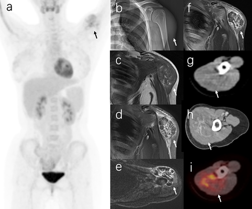 Figure 1 The figure shows the PET/CT images of a patient with IMH in the triceps brachii muscle. The maximum intensity projection (MIP) images show a solitary lesion of abnormal 18F-FDG activity in the left shoulder (a, black arrow). The X-ray examination reveals a dense shadow in the left shoulder with blurred margins (b, arrow). On MRI, the mass has mixed intensity abnormal signals on T1-weighted images (c, arrow) and T2-weighted images (d, arrow). The diffusion-weighted imaging (DWI) shows a mainly iso-hypointensive signal mixed with grid-like high signal (e, arrow). The contrast-enhanced coronal MRI displays a hyperintense, well-defined enhancing mass (f, arrow). CT scans show a lobulated mixed-density mass in the triceps muscle with ill-defined margins (g, arrow) and marked inhomogeneous enhancement (h, arrow). The axial fusion PET/CT (i, arrow) shows a 56mmx45mm mass in the triceps brachii muscle with a SUVmax of 5.2.