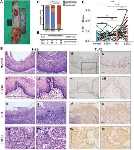 Figure 1 Inflammation levels and TLR3 protein expression in esophageal tissues at different pathologic stages. (A) Schematic diagram of esophageal tissues sampling. The stars in various colors from top to bottom in the esophageal mucosa represent respectively: esophageal squamous cell carcinoma (ESCC, inside tumor), tumor proximal tissue of early lesions for identifying esophageal squamous simple hyperplasia (ESSH) and intraepithelial neoplasia (IEN), and distant non-malignant tissue. (B) Microscopic images of esophageal tissues at different pathologic stages with different levels of inflammation and TLR3 protein expression, i–ii, Normal: rare inflammation; v–vi, ESSH: general mild inflammation; ix–x, IEN: common moderate or severe inflammation; xiii–xiv, ESCC. IHC showing TLR3 expression from normal (iii–iv), ESSH (vii–viii), IEN (xi–xii) to ESCC (xv-xvi). Scale bars:100 μm (i, iii, v, vii, ix, xi, xiii and xv) and 40 μm (ii, iv, vi, viii, x, xii, xiv, and xi). (C) Correlation between inflammation score and histologic types. Rho indicates Spearman rank correlation coefficient. (D) The protein expression levels of TLR3 in 37 paired esophageal tissues: Normal, ESSH, IEN, and ESCC samples. P < 0.0083 (α=0.05/6) was considered statistically significant in pairwise comparison. (E) Correlation between inflammation score and TLR3 H-score (the High and Low TLR3 groups are based on the ROC curve). **P < 0.01; *** P < 0.001; “ns” indicates no significance.