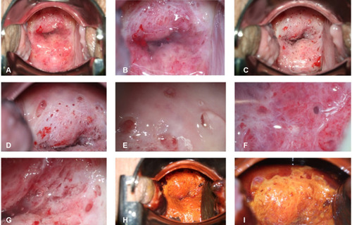 Figure 1 Colposcopy image. (A) After placing the speculum, the appearance of the cervix; (B) After magnification of the cervical colposcopy image, clear watery secretions covering the cervix can be seen; (C) The appearance of the cervix after the secretion is wiped off with a cotton swab (D–F). A lot of large gland openings can be observed on the surface of the cervix, and the gland opening is continuously secreting huge amount of watery secretions. (G) Abnormal blood vessels on the surface of the cervix can be observed. (H and I) Colposcopy image of the cervix after using Lugol’s iodine.