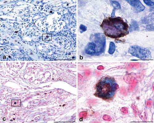 Figure 3. The cells expressing PrPC in the human carotid body are mast cells. Tissue sections of human CB immunohistochemically stained for PrPC expression and counterstained with either TB/ammonium sulphate (Panels a, b) or alcian blue/nuclear fast red (Panels c, d) demonstrate that mast cells express PrPC. PrPC expression is indicated by the brown reaction product, while the mast cell phenotype is indicated by purple (panel b) or blue (panel d) staining of the cell cytoplasm. The colocalization of the two markers in the same cell indicate that mast cells express PrPC. Scale bars: Panels a, c = 100 µm; Panels b, d = 10 µm.