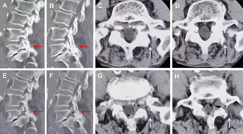Figure 3 Preoperative and postoperative CT (computed tomography). (A–D) Preoperative CT highlighting the left L5 pars defect (red arrow) and the unique pathology of foramen stenosis caused by lumbar isthmic spondylolisthesis (white arrow), including bone spurs extending from the proximal lamina stump to the extraforaminal exit zone and bone spurs distributed at the edge of the foramen, lower vertebral endplate. (E–H) Postoperative CT demonstrating the removal of the pathological factor compressing the L5 exiting nerve root (red arrow) and enlargement of the foramen (white arrow).