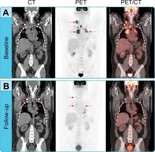 Figure 2 Assessing treatment response using PET and CT.