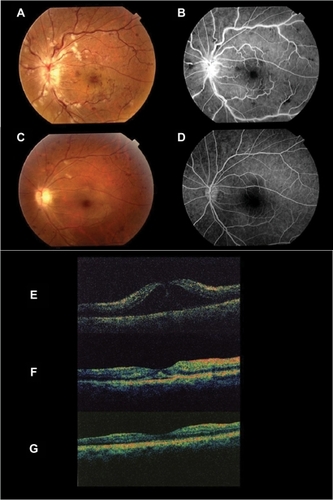 Figure 1 The flourescein angiography photograph (B) shows a fluorescence block for multiple dot subretinal hemorrhage, cotton-wool spots and vein meandering with the color fundus photograph (A), but it does not show the avascular area. Three months later, the fundus photograph (C) shows an almost normal retina appearance although dot subretinal hemorrhage and cotton-wool spots remain. The flourescein angiography photograph (D) shows no abnormality. The OCT shows remarkable macular edema, with the macular thickness indicated at 638 μm (E). (F) Macular thickness the following day shows 220 μm. The retinal thickness was reduced to 140 μm three months later.