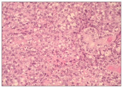 Figure 2 Diffuse proliferation of small atypical lymphoid cells, partly effacing the mucosal glands (hematoxylin and eosin, 40×).
