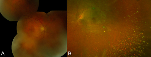 Figure 3 Mimickers of asteroid hyalosis – (A) montage fundus photography of ocular amyloidosis and (B) Optos imaging of de-hemoglobinzed vitreous hemorrhage resembling AH.
