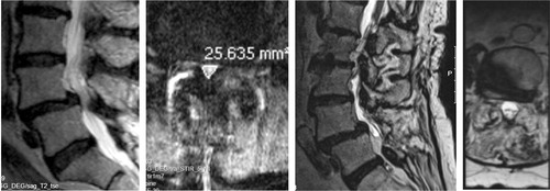 Figure 11. 72-year old woman with DS and scoliosis as well as fluid in the facet joints before she was operated with decompression only in 2002, preoperative MRI (left). She reported excellent clinical outcome. In 2014 she had an MRI of the whole spine as she had pain in the thoracic spine and pancreatic cancer. The DS and the scoliosis had not progressed despite the lack of stabilizing surgery (right).