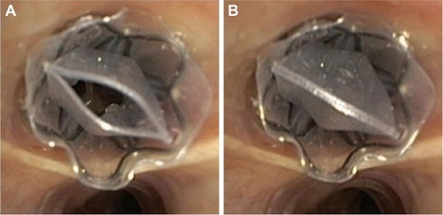 Figure 4 Implanted one-way endobronchial valve.
