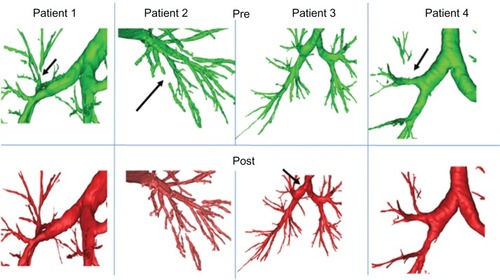 Figure 2 Examples of the comparison of individual airways in different COPD patients as assessed with 3D CT analyses at baseline and after intrapulmonary percussive ventilation (IPV) treatment.