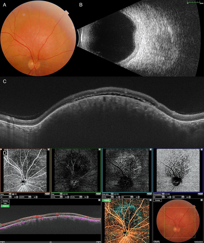 Figure 6 Multimodal imaging in circumscribed choroidal hemangioma. (A) Color fundus photograph shows the choroidal hemangioma superior to the optic disc in the right eye. (B) B- mode ultrasonogram demonstrates the acoustically solid tumor. (C) Swept source optical coherence tomography shows dome-shaped choroidal mass, expansion of choriocapillaris without compression, and subretinal fluid overlying the tumor. (D) Swept source optical coherence tomography angiography demonstrates interconnected tumor vessels in the choriocapillaris slab. Hyporeflectivity in the superficial and deep retinal slabs is due to compression from the tumor and focal hyperreflectivity in the outer retinal slab is due to retinal pigment epithelium atrophy.