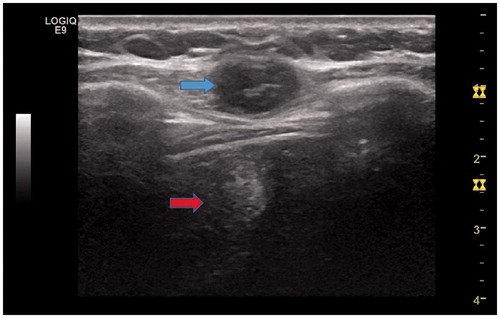 Figure 1. A 46-year-old female patient with abdominal wall implants from hepatocellular carcinoma (HCC) after US-MWA treatment. US image shows one low level echo mass (3.1 × 2.5 × 2.2 cm) located on the abdominal wall (blue arrow). There is a high level echo field located behind the mass, and it is MWA field (red arrow).