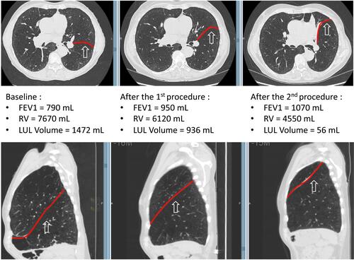 Figure 2 Example of a “Great responder” patient with progressive lung volume reduction on CT-scan resulting in a progressive decrease in RV and a progressive improvement in FEV1.
