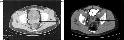 Figure 10. (A) CT slice showing peritoneal metastases between right and left seminal vesicle. A fat plane is absent. (B) CT slice a few millimetres above seminal vesicles with tumour layered out on peritoneum of pararectal fossa (rabbit ears appearance).