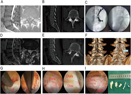 Figure 4 A 23-years-old male patient who was diagnosed with highly migrated disc herniation at the level of L4-5 and accompanied with cauda equina syndrome and paralysis of L5 nerve root. (A and D) Preoperative MRI scan revealed the central herniated disc. Postoperative MRI scan showed the complete detachment of herniated disc and restoration of dural sac. (B and E) Preoperative and postoperative CT scan of the level of L4-5. Postoperative CT showed the enlarged spinal canal. (C) Intraoperative radiography of placement of working cannulas. (F) Postoperative CT scan presented that part of lamina were removed and three-dimensions reconstruction provided the overview of posterior view of lamina. Left diagram was preoperative CT reconstruction, while the right was postoperative. (G) Laminectomy punch and spinal endoscopic Kerrison punch were used to remove ligamentum flavum (LF) and inner part of ipsilateral facet joint. (H) The overview of the extruded dural sac in the left diagram and working cannulas were rotated to protect the dura and expose the herniated disc in the right diagram. (I) The endoscopic overview of the dural sac and nerve root (NR) in the slack status and herniated disc.