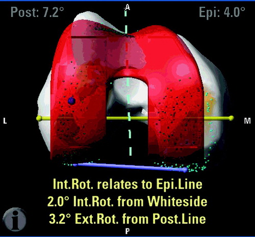 Figure 2. Screenshot during the navigation process: calculation of the angle (in this case 3.2°) between the TEA (yellow line) and PCA (blue line).“Ext.Rot. from Post.Line” refers to the rotation of the femoral component in relation to the PCA. By definition, the femoral component of the prosthesis is always positioned parallel to the TEA. Therefore, the number of degrees by which the prosthesis is rotated in relation to the PCA is equivalent to the condylar twist angle. [Color version available online]