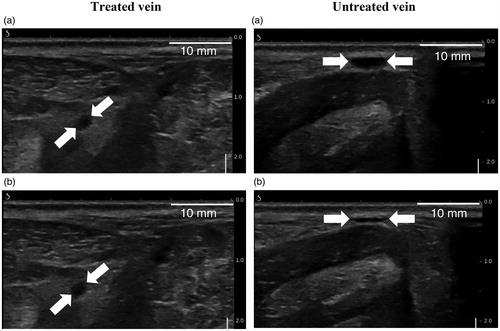 Figure 9. Ultrasound images showing a non-compressible treated vein at 30 days post-treatment (left column) and a compressible untreated vein (right column). Veins are pointed by white arrows. (a) and (b) represent respectively the sheep veins before and after external ultrasound compression.