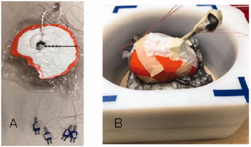 Figure 3. Experimental setup of magnetic nanoparticle (MNP) balloon implant heating: (A) 2-cm diameter MNP-filled balloon buried 4-cm deep in the central plane of a split-apart human skull model that is filled with brain tissue-equivalent phantom and 2.5-mm spaced thermocouples to measure radial penetration of heating. (B) Split-apart skull/brain model assembled inside the head coil for application of radiofrequency magnetic field.