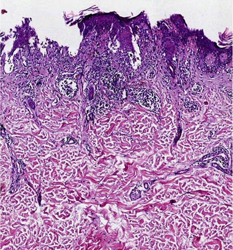Figure 1 HE staining of LP (case group) showing hyperkeratosis of the epidermis, band like infiltration of lymphocytes.(HE x 100).