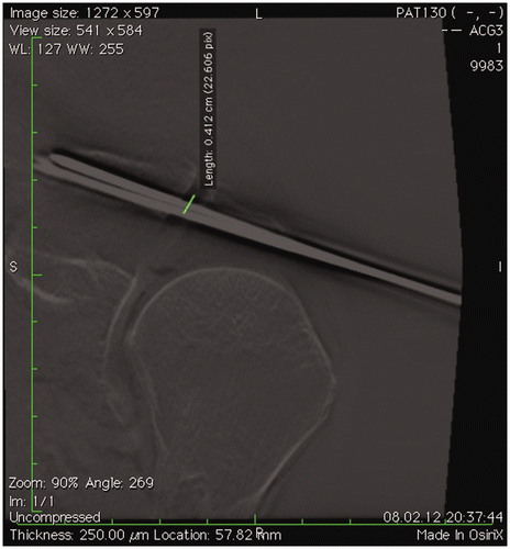 Figure 2. Radiological analysis with the use of the OsiriX software. Multiplanar reformations are created, and the distance of the K-wires from the center of the AC joint is measured.