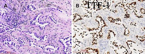 Figure 4 (A) Tumor C was well differentiated. The central part of the nodule, which comprised 60% of the tumor, was an invasive acinar cell carcinoma; (B) Immunostaining showing that tumor cells are positive for the expression of TTF-1.