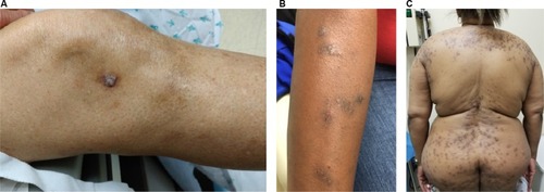 Figure 1 Clinical images of patients with prurigo nodularis.