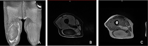 Figure 1 A 62-year-old male patient with a well-differentiated liposarcoma in his right thigh. (A). Fat-suppressed T2-weighted image reveals a well-defined, low-signal soft tissue mass in the right thigh, surrounded by high-signal edema. (B) T1-weighted image shows a mass with a fatty signal and a small amount of flocculent low-signal non-fatty area in the center. (C) Fat-suppressed T1-weighted contrast-enhanced image reveals only mild enhancement in the non-fatty area.