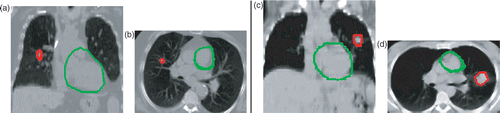 Figure 5. Results of automatic heart segmentation (green contour) for two cases where a tumor (red contour) is present in the right (a, b) and left (c, d) lungs. [Color version available online.]