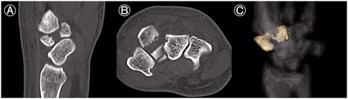 Figure 2. Computed tomography (CT) image of an isolated left trapezoid coronal shearing fracture in a 40-year-old male. (A) The preoperative sagittal CT image shows a coronal shear fracture at the center of the left trapezoid with a gap of 6 mm. The base of the second metacarpal bone is interposed between the fracture fragments. (B) The axial CT image shows that the palmar fragment of the trapezoid is in its original position, but the dorsal fragment is displaced dorsally. (C) On the three-dimensional CT, only the trapezoid is highlighted. A large gap and dorsal displacement of the dorsal fragment is confirmed anatomically and three-dimensionally. No abnormal positioning of the trapezoid or the other carpal bones is observed.