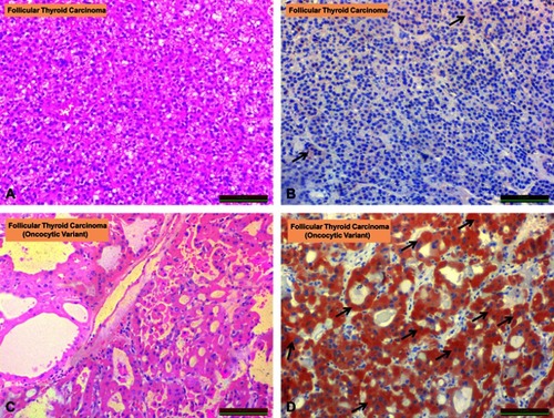 Figure 3 Comparison of irisin expression in follicular thyroid carcinoma and follicular thyroid carcinoma (oncocytic variant). (A) Follicular thyroid carcinoma (H&E staining). (B) Follicular thyroid carcinoma (irisin staining). (C) Follicular thyroid carcinoma (oncocytic variant; H&E staining). (D) Follicular thyroid carcinoma (oncocytic variant; irisin staining). Arrows show irisin immunoreactivity (black arrows).Abbreviation: H&E, hematoxylin and eosin.