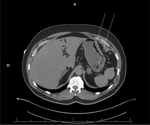 Fig. 1 A non-contrast CT abdomen (axial) revealing gastric intramural air suspicious for gastric emphysema (white arrows) with a small amount of air in peri-gastric veins (dotted arrows).